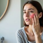 Identifier et gérer efficacement la rosacée : guide complet